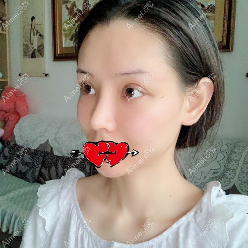 去杭州艺星找张龙医生做肋骨鼻术后第15天照片