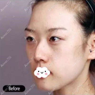 驼峰鼻女生在韶关涵美做鼻综合修复后鼻尖变化也很大！