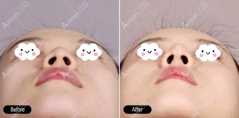 鼻综合术后鼻头鼻尖变化对比图