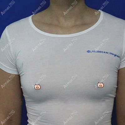 趙葉向東做完隆胸術(shù)后7天胸部微腫