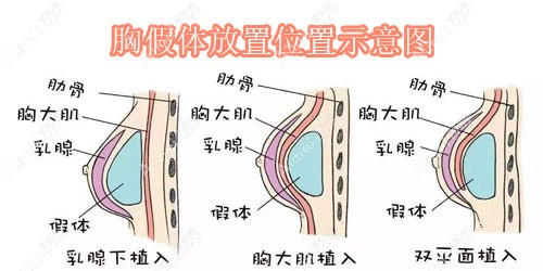 胸假体放置位置示意图