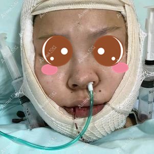 在重庆华美做下颌角手术当天 在重庆华美做下颌角手术当天