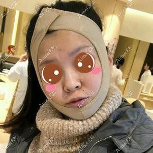 找潘宝华院长做下颌角手术后5天 找潘宝华院长做下颌角手术后5天