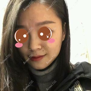 找潘宝华院长做下颌角手术后半个月 找潘宝华院长做下颌角手术后半个月