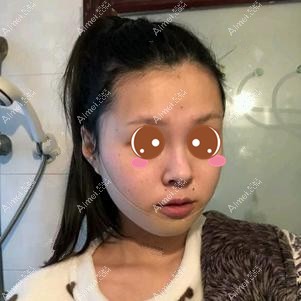 找潘宝华院长做下颌角手术后一周 找潘宝华院长做下颌角手术后一周