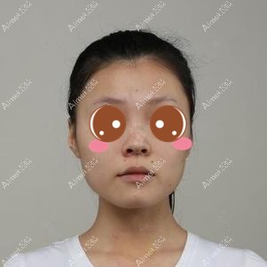 在重庆华美做下颌角手术前 在重庆华美做下颌角手术前