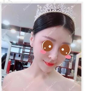 找潘宝华院长做下颌角手术半年效果 找潘宝华院长做下颌角手术半年效果