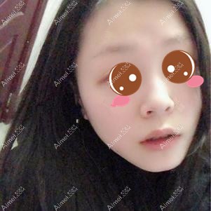 找潘宝华院长做下颌角手术30天效果 找潘宝华院长做下颌角手术30天效果