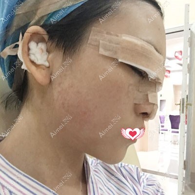 真人案例了解江门华美美容医院眼鼻手术怎么样？