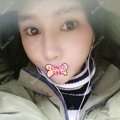 在南宁韩成做脂肪填充面部术后1个月恢复效果