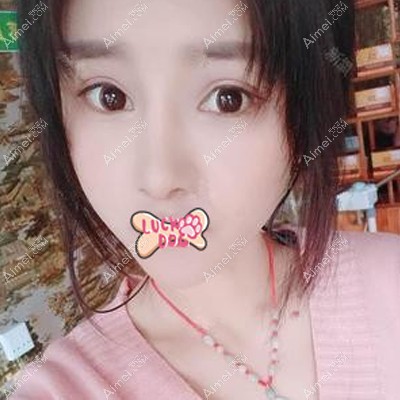 刘斌医生为我填充脂肪后4个月完全消肿