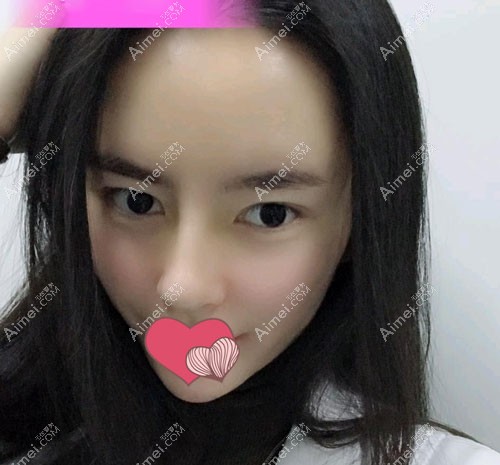 在邯郸京美整形做假体隆鼻三个月的恢复效果图
