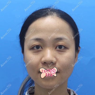 黄意辉做鼻综合实记：用射极峰膨体+耳软骨隆鼻后效果自然