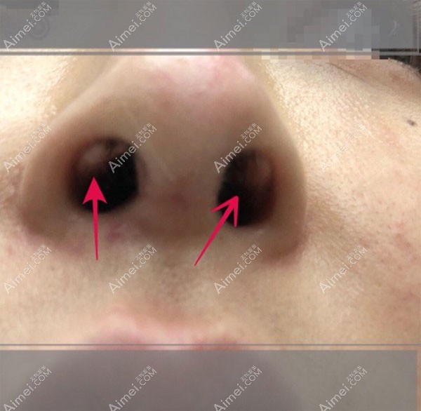 鼻综合2个月出现疤痕增生.jpg