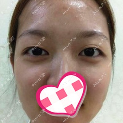 普潇医生轻松修复了我闭眼有疤睁眼三层皮的失败双眼皮
