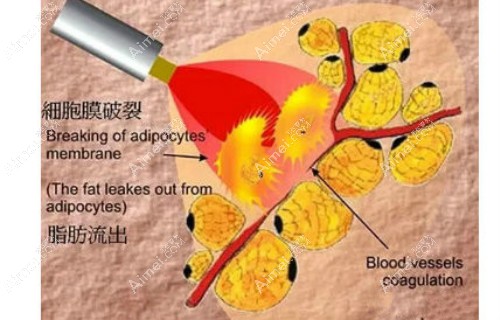 皮层光焊消除脂肪填充硬块