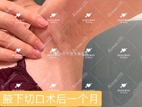 假体隆胸术后1个月腋下疤痕情况.jpg