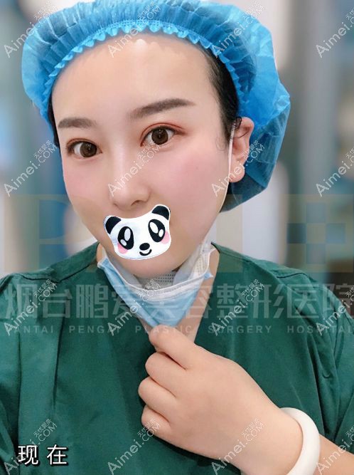 烟台鹏爱佳妍魏璐做的三眼皮修复手术1年了.jpg