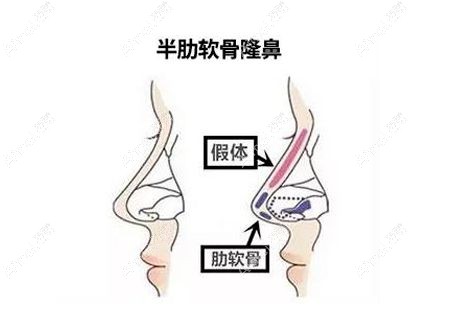 半肋软骨鼻综合中硅胶和膨体放置位置示意图.jpg