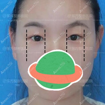 在郑州东方做全切双眼皮前化妆要1小时,现在10分钟就能出门