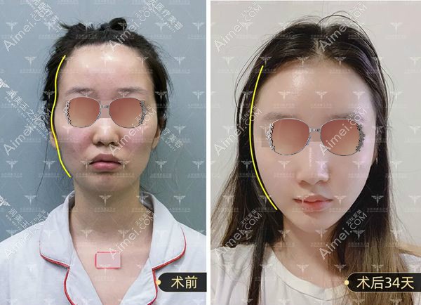 顾客在王明利医生做自体脂肪填充全脸1个月的对比照片.jpg