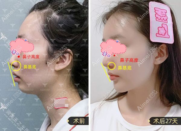 王明利在自体脂肪填充中改善鼻基底的术后效果图.jpg