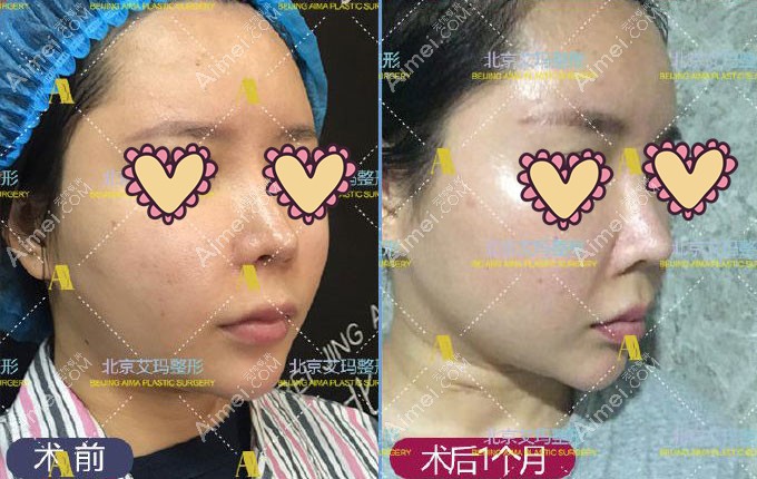 北京艾玛取面部生长因子术前术后对比效果图.jpg