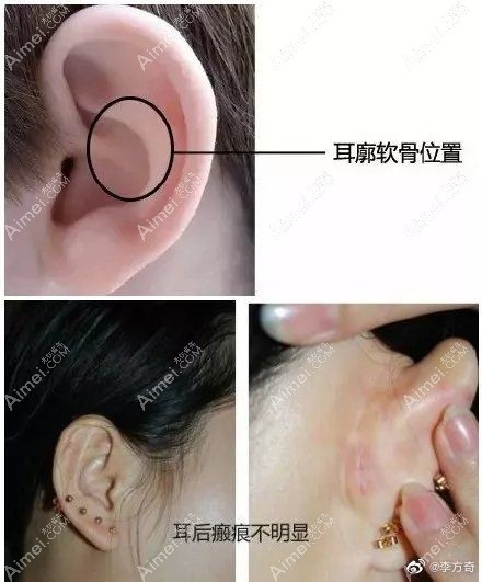 北京艾玛整形取耳软骨的疤痕不明显.jpg