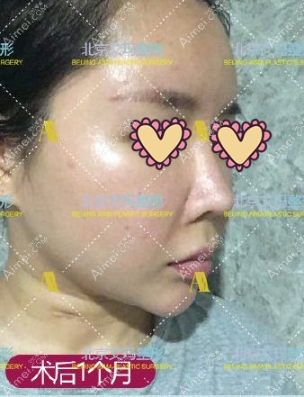 面部注射生长因子取出1个月效果图.jpg