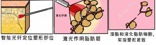 光纤溶脂祛眼袋的原理