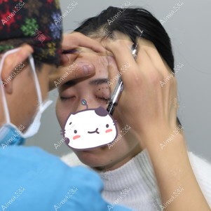 在宜昌蕾帝做全切双眼皮手术当天