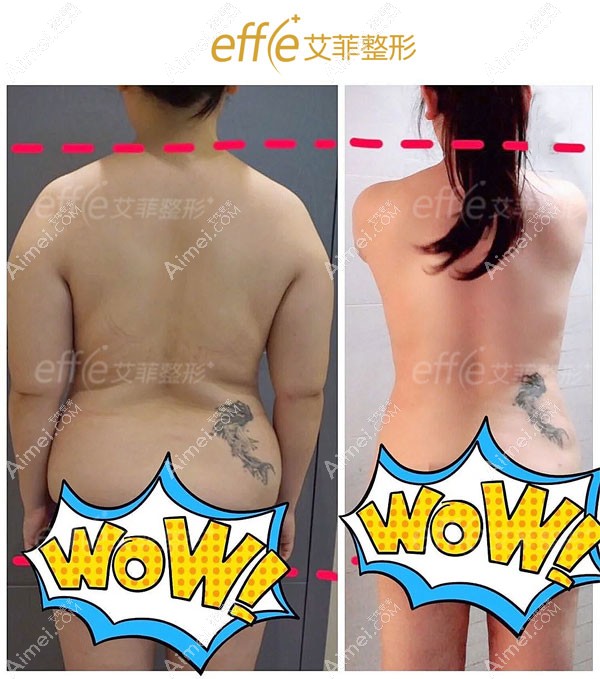 青岛艾菲腰腹环吸手术术前术后对比效果图.jpg