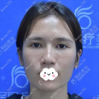 广州韩后崔东鼻修复案例：鼻子疤痕 鼻小柱缺损修复的很好