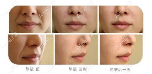 王毅超教授注射爱贝芙填充鼻唇沟1天后对比效果.jpg