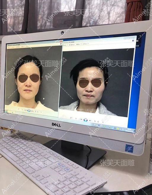 我在北京圣嘉新做完颧骨和下颌角整形术后对比效果明显.jpg