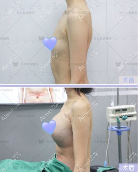 北京东方和谐孙泽芳做自体脂肪丰胸手术效果对比图.jpg