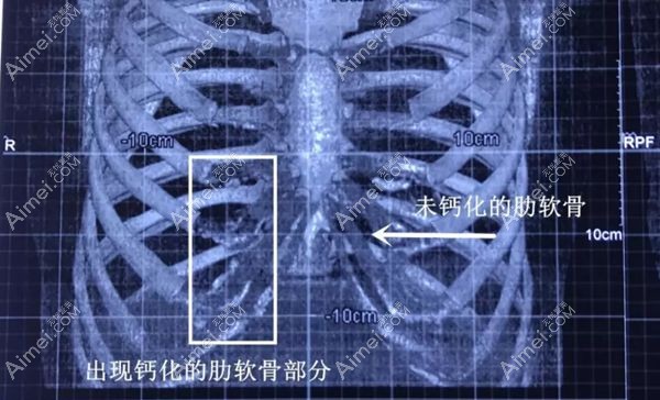 胸部CT片看软骨是否钙化.jpg