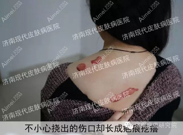 20年的疤痕疙瘩增生来济南现代皮肤病医院治疗前情况.jpg