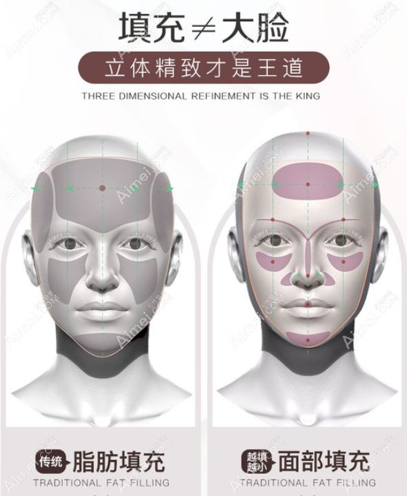 王东医生做的艺术面雕脸越填越小.jpg