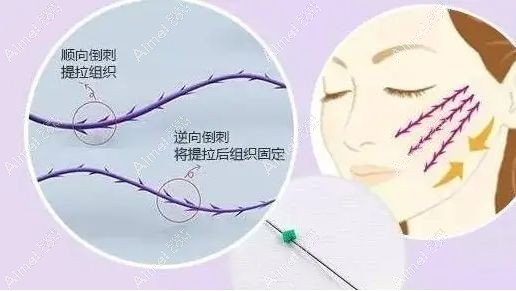 面部埋线提升后会出现皮下疤痕后遗症.jpg