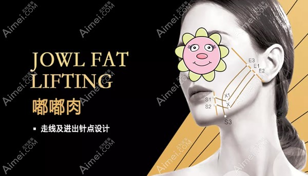 嘟嘟肉和双下巴埋线提升需要几根线 嘟嘟肉和双下巴埋线提升需要几根线