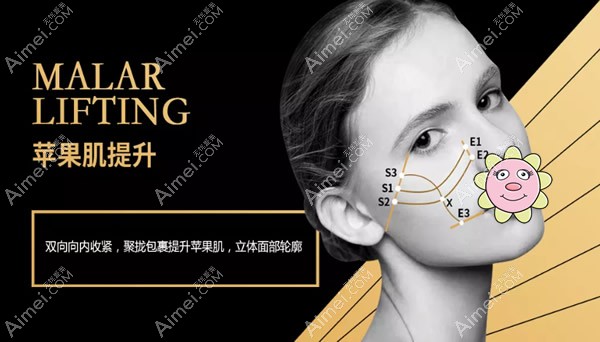 苹果肌和中面部埋线提升布线图 苹果肌和中面部埋线提升布线图