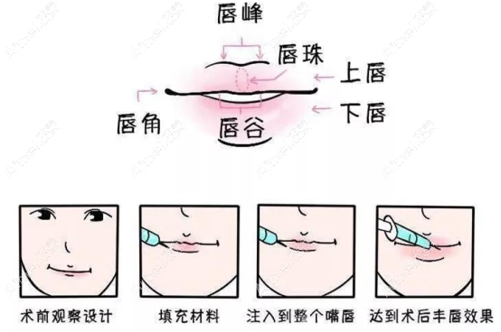 玻尿酸丰唇手术