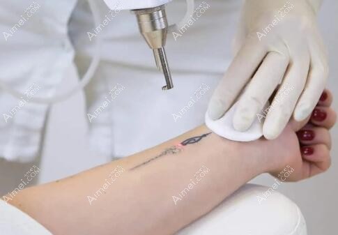 激光洗纹身能洗干净吗 激光洗纹身能洗干净吗