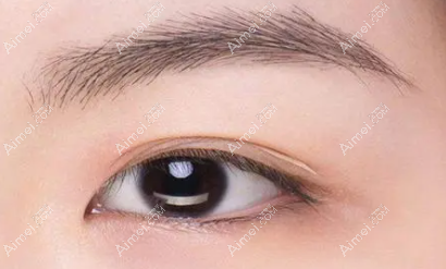 双眼皮贴长期贴会导致眼皮下垂吗？