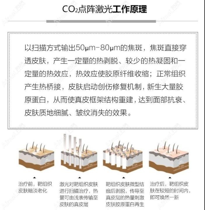 点阵激光祛法令纹原理图
