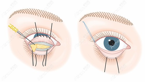 眼袋脂肪填充泪沟手术过程