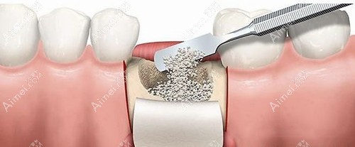 骨粉骨膜在牙槽骨中的应用