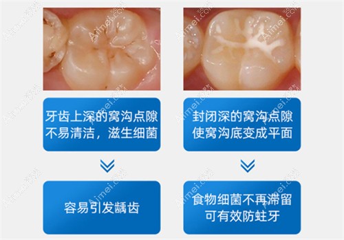 儿童牙齿窝沟封闭的作用