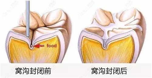 窝沟封闭是长一颗做一颗吗